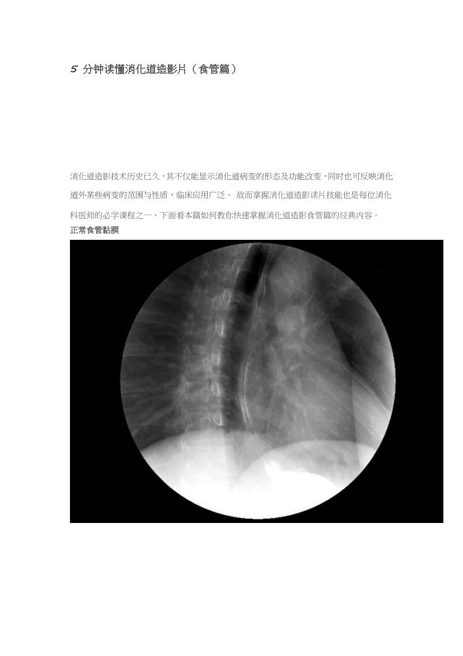 5-分钟读懂消化道造影片(食管篇)_第1页