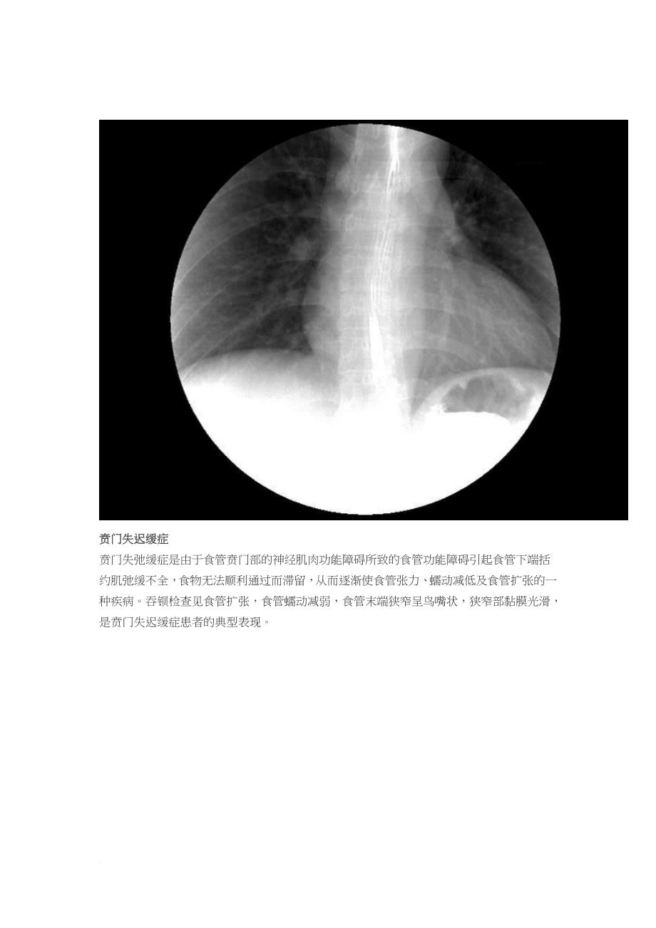 5-分钟读懂消化道造影片(食管篇)_第2页