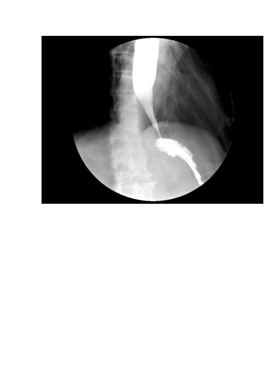 5-分钟读懂消化道造影片(食管篇)_第3页