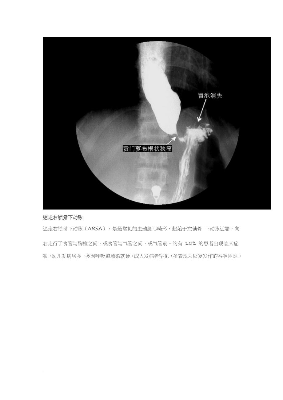 5-分钟读懂消化道造影片(食管篇)_第4页