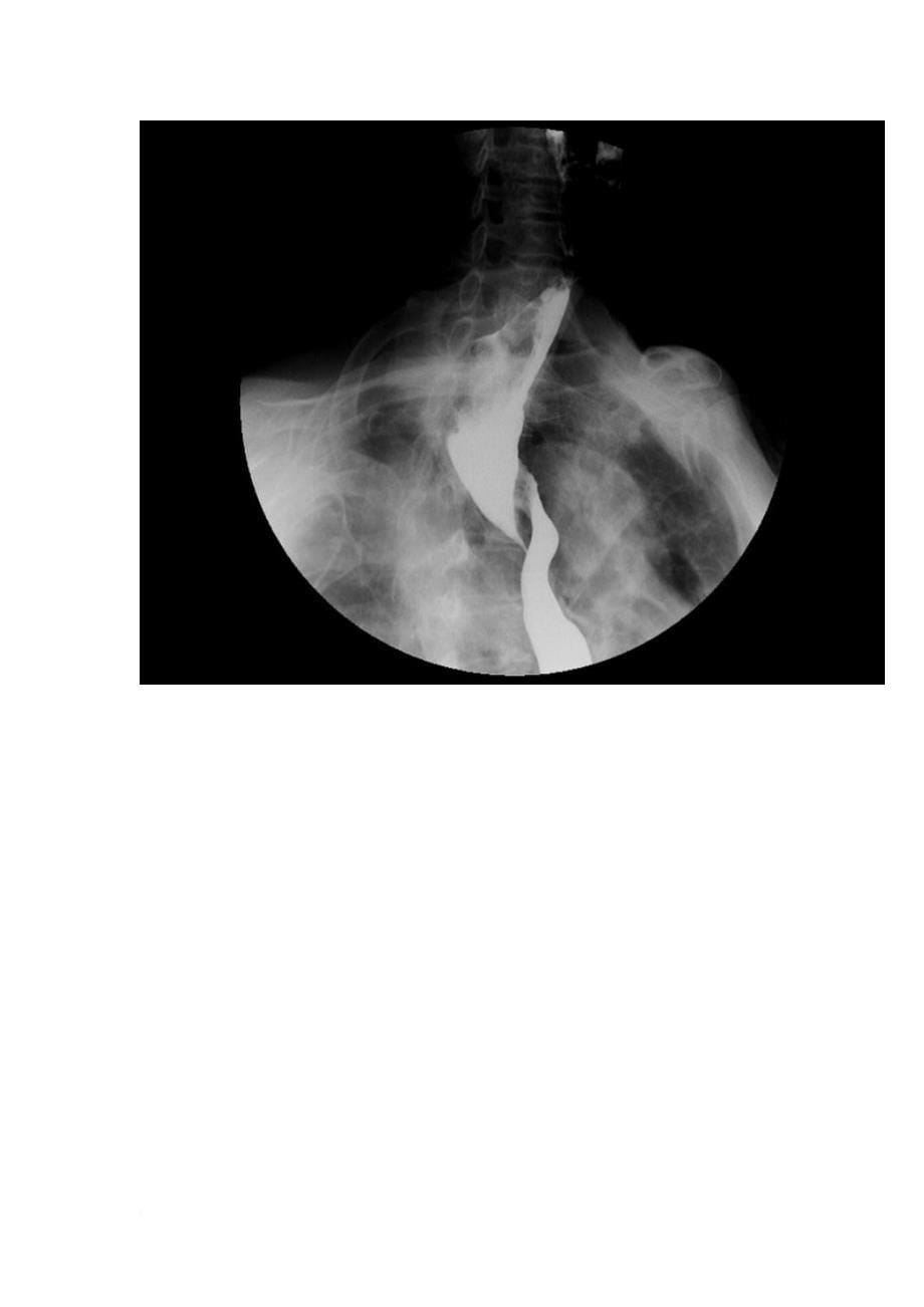 5-分钟读懂消化道造影片(食管篇)_第5页