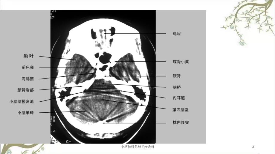 中枢神经系统的ct诊断_第3页