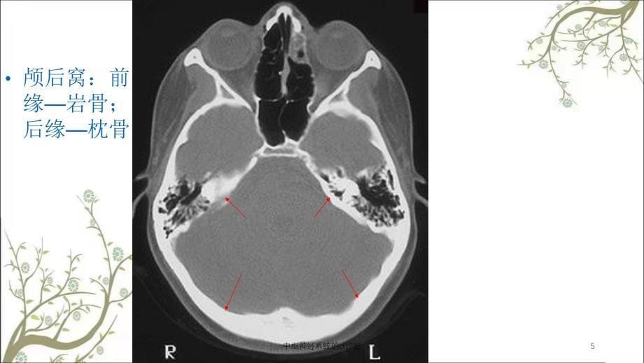 中枢神经系统的ct诊断_第5页