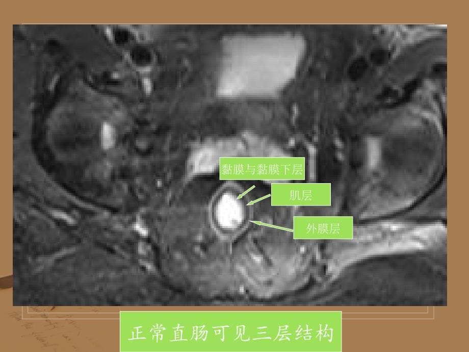 结直肠癌的3tmri诊断与分期_第5页