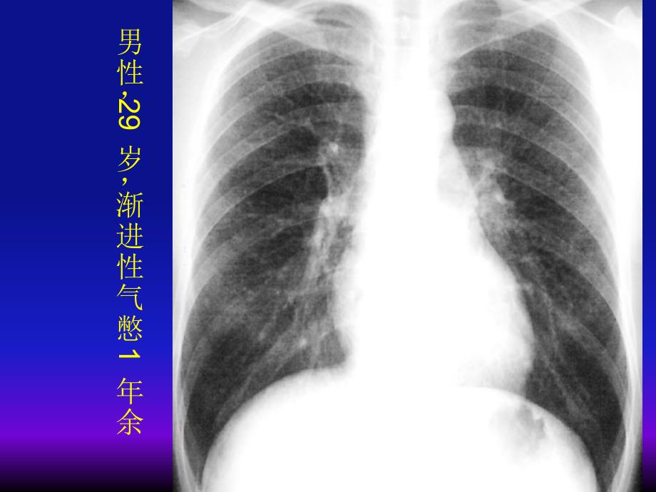 医学-弥漫性肺疾病的影像学诊断思路_第4页