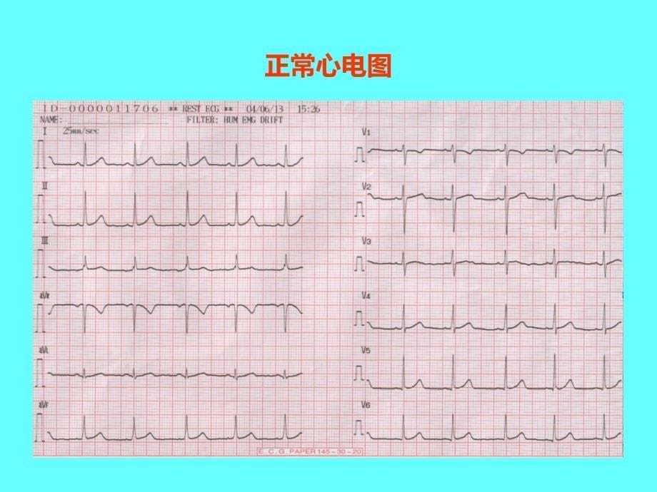 临床危急心电图的识别.ppt_第5页