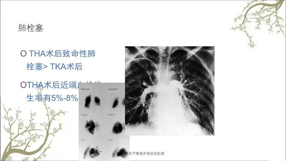 全髋关节置换并发症的处理_第5页