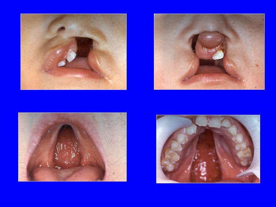 口腔颌面外科学：唇顎裂畸形的序列治療_第2页