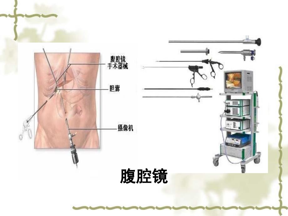 腹腔镜胆囊切除术在小儿腔镜外科中的应用_第3页