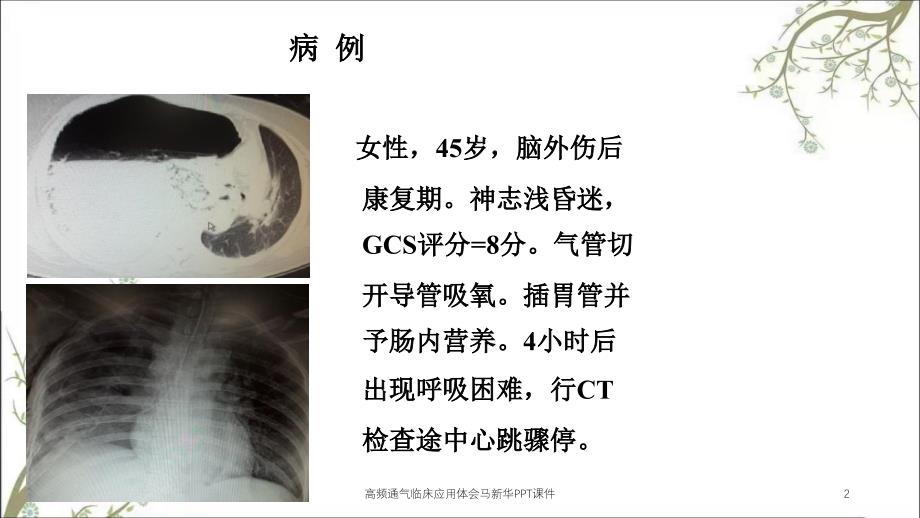 高频通气临床应用体会马新华PPT课件_第2页