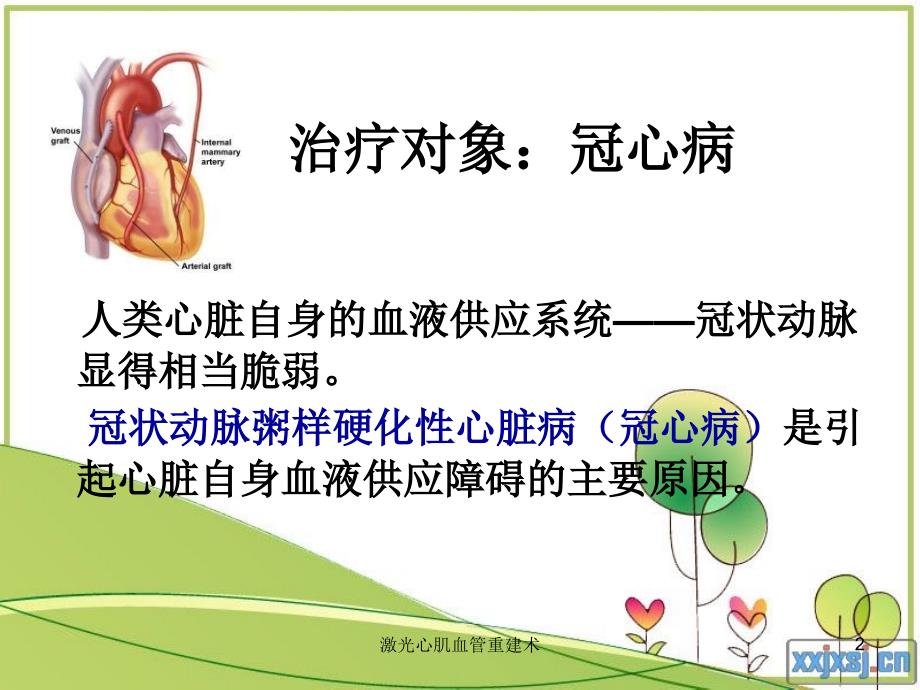 激光心肌血管重建术课件_第2页