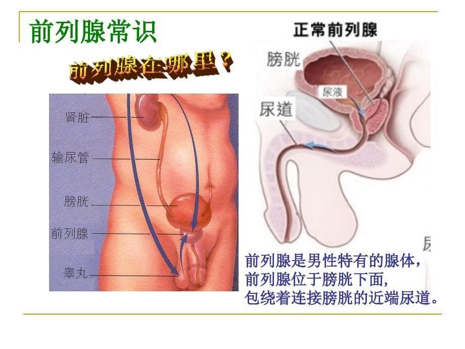 外科护理学课程-课件-30 前列增生_第5页