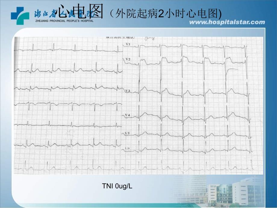 胸痛胸前导联STT改变浙江省人民医院心内科徐强_第3页