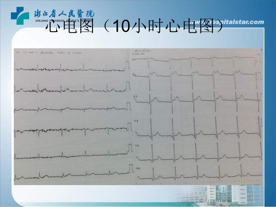 胸痛胸前导联STT改变浙江省人民医院心内科徐强_第4页