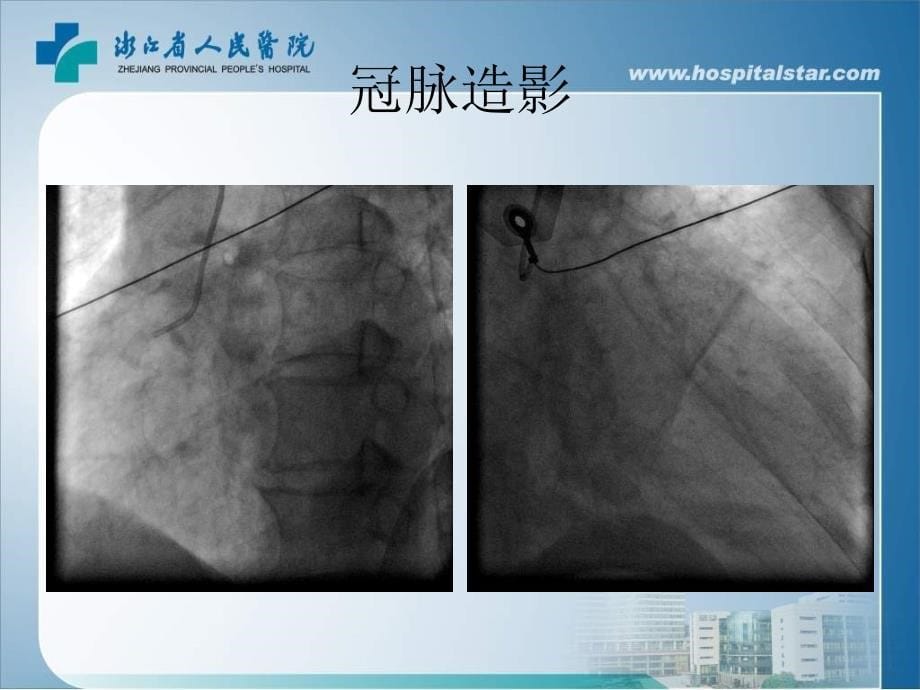 胸痛胸前导联STT改变浙江省人民医院心内科徐强_第5页