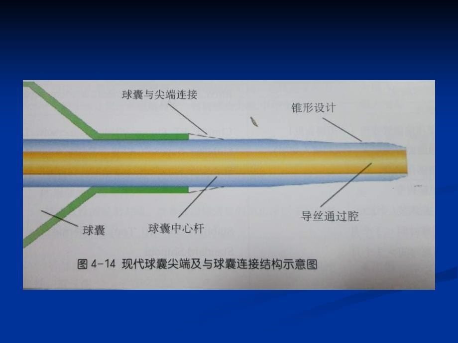 冠状动脉介入治疗球囊的选择_第5页