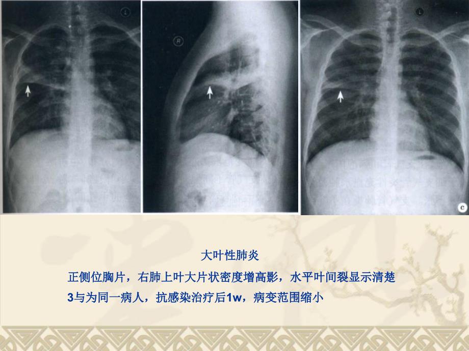 《肺部炎症ct表现》PPT课件_第4页