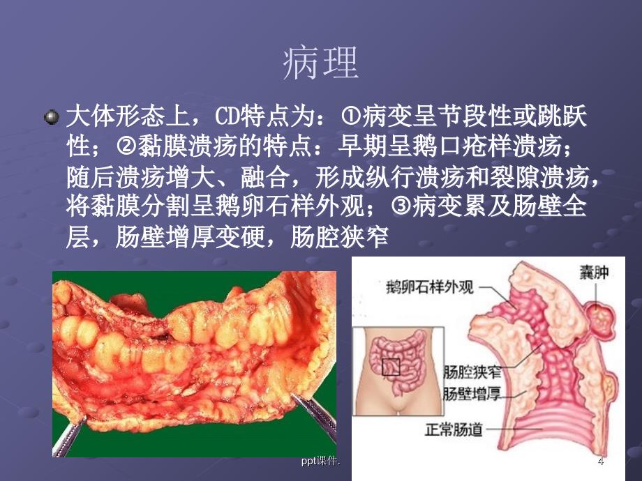 克罗恩病CTMRI诊断ppt课件_第4页