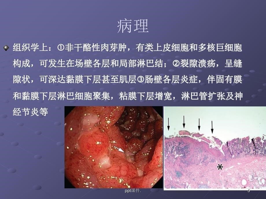 克罗恩病CTMRI诊断ppt课件_第5页