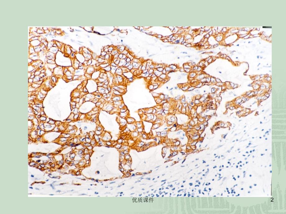 免疫组化结果判断及常见问题的分析#高级教育_第2页