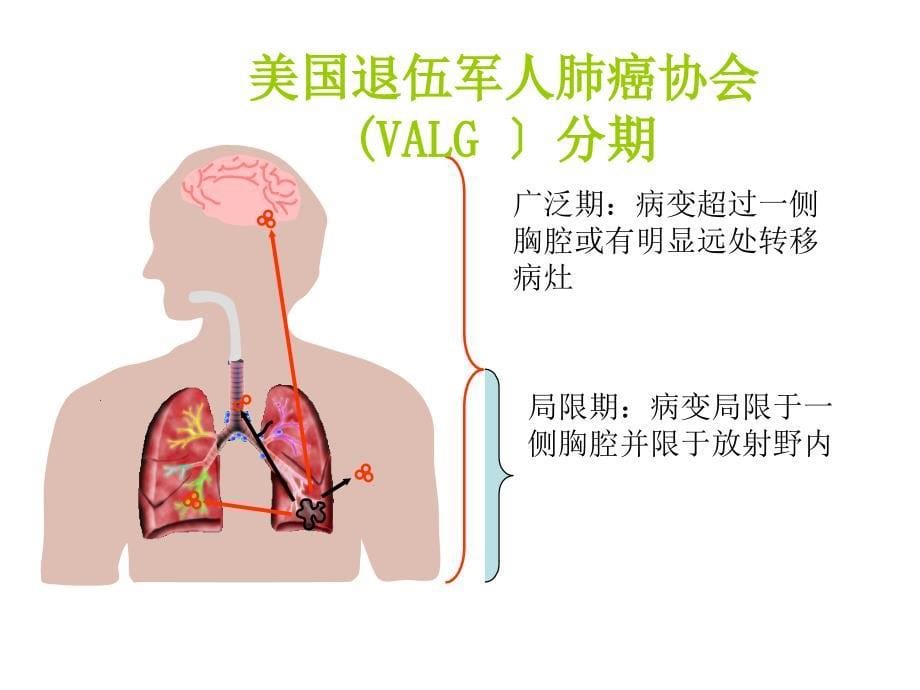 小细胞肺癌热点及争议_第5页