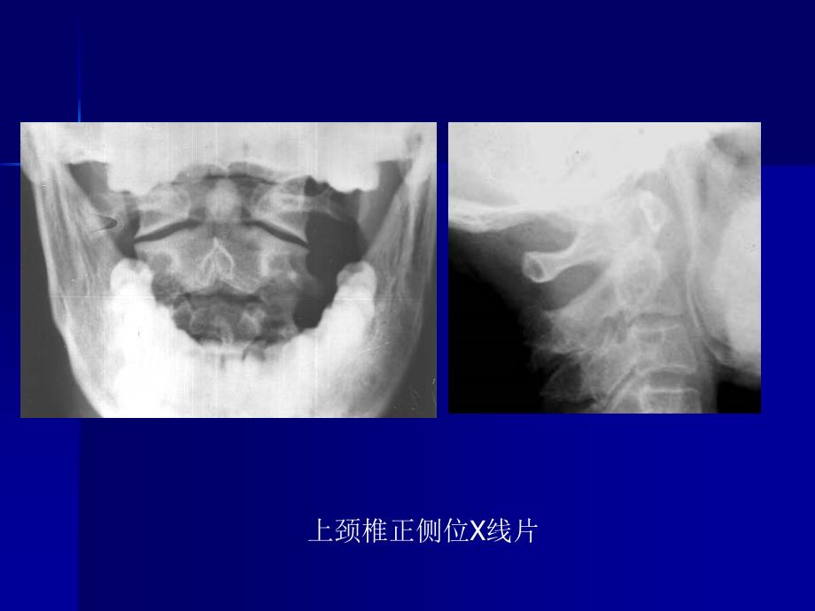 脊柱外科影像学检查_第3页