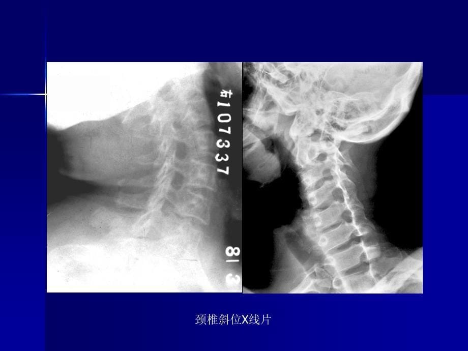 脊柱外科影像学检查_第5页