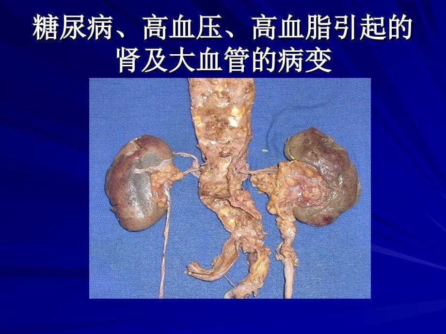 糖尿病饮食社区教育_第5页