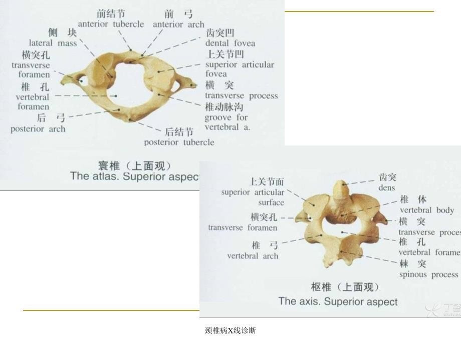 颈椎病X线诊断_第5页