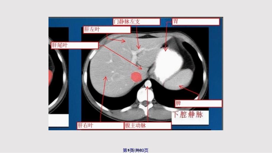 c腹部ct示意图实用教案_第1页