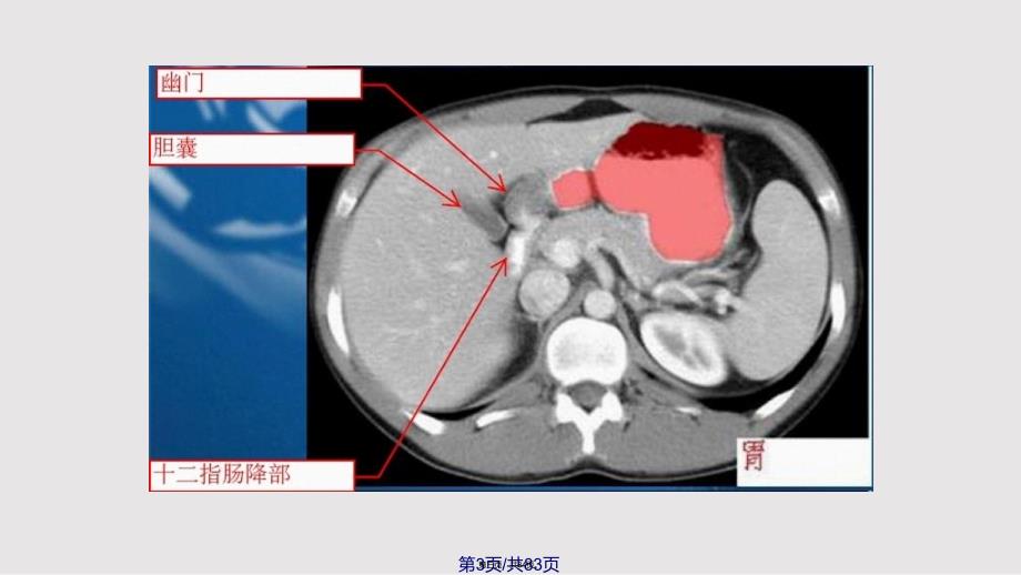 c腹部ct示意图实用教案_第3页