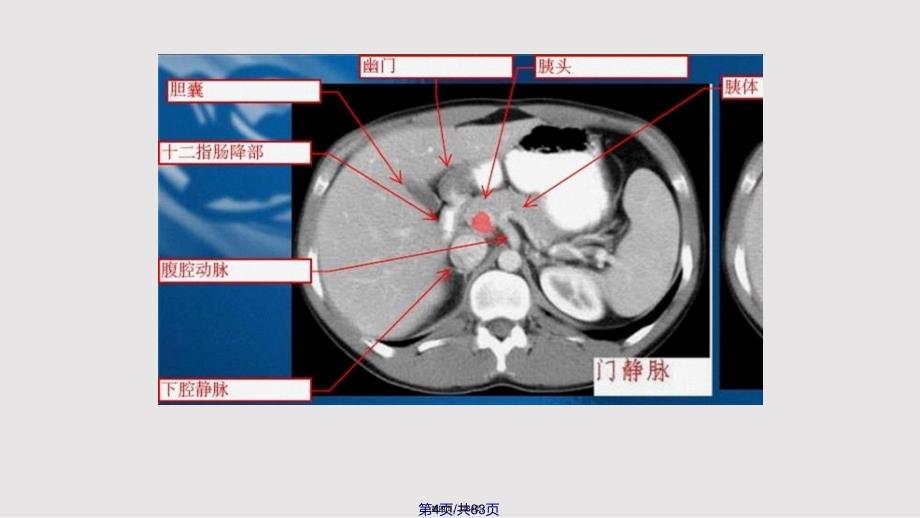 c腹部ct示意图实用教案_第4页