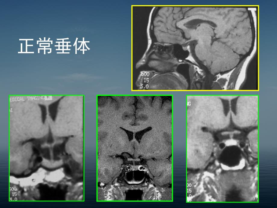 鞍区病变的CT及MRI诊断ppt演示课件_第3页