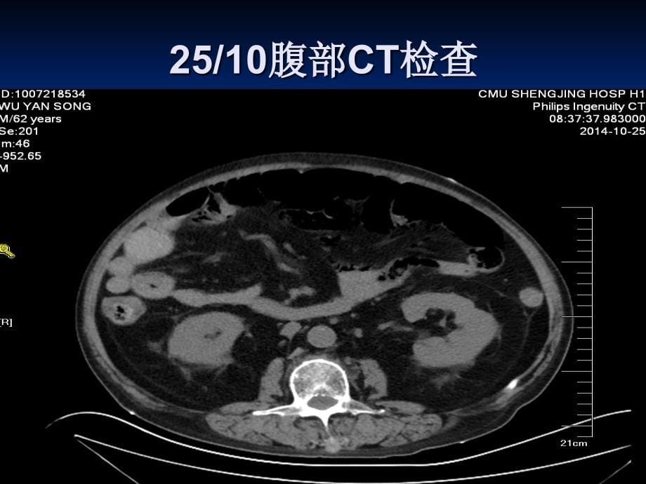 糖尿病酮症的诊断与治疗完整版_第5页