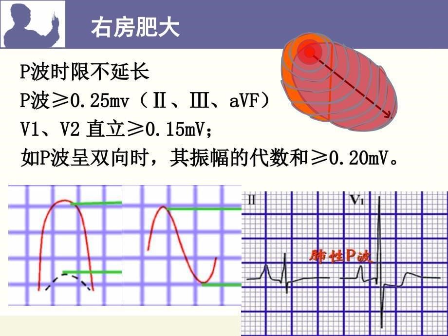 心房、心室肥大、心梗_第5页