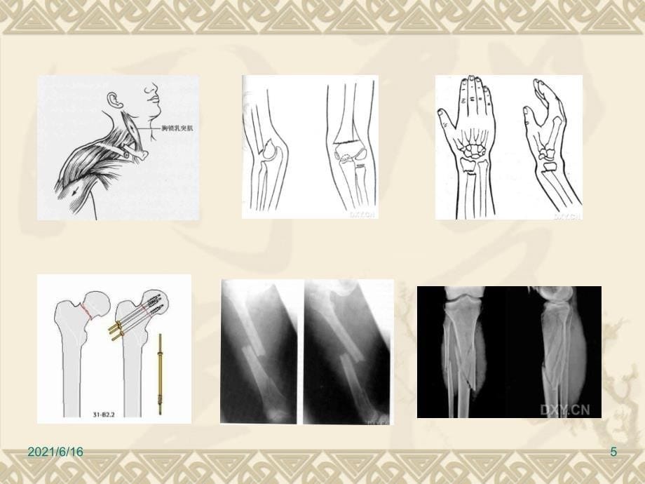 四肢骨折的手术配合演示文稿_第5页
