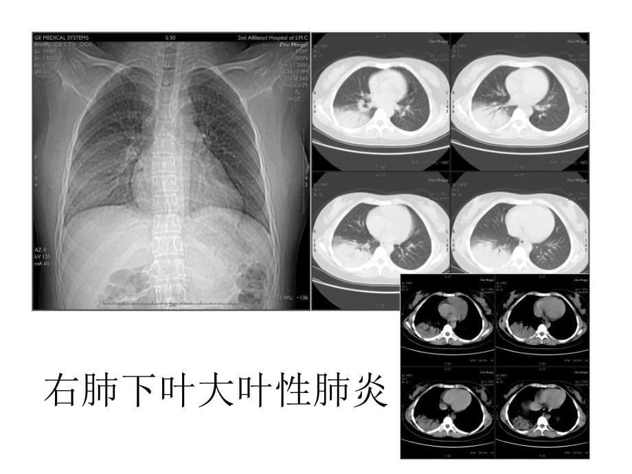 规培结能考试考前辅导：放射读片_第5页