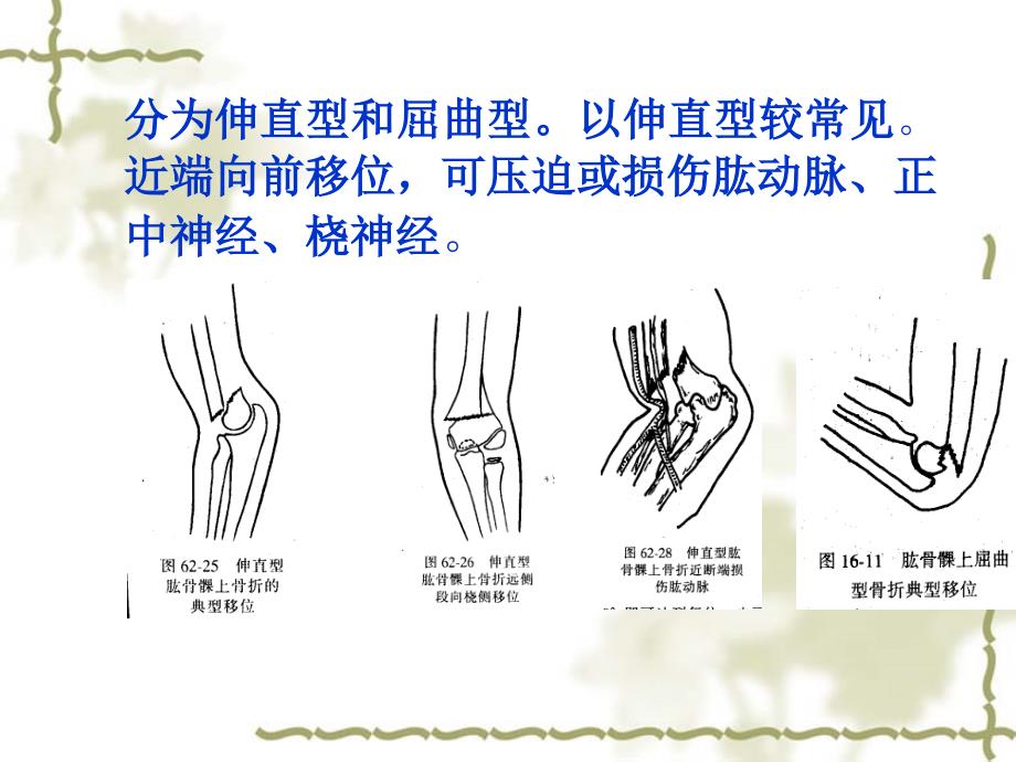 常见四肢骨折病人的护pt课件_第3页