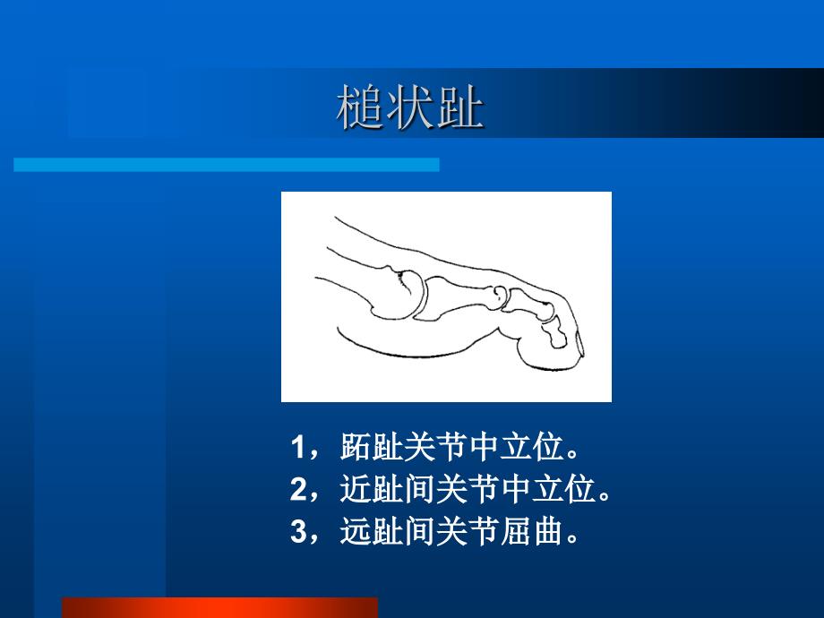 锤状趾、槌状趾、爪形趾.ppt_第3页