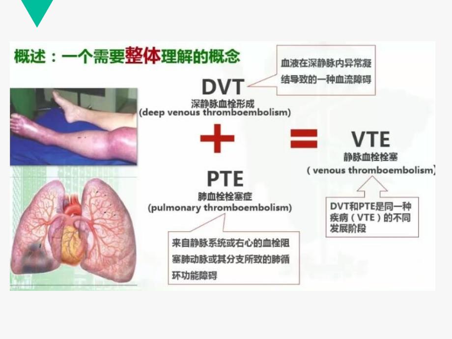 《护士与DVT的预防》PPT课件_第4页