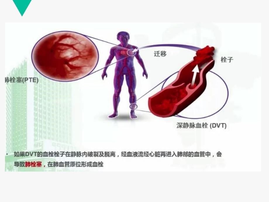 《护士与DVT的预防》PPT课件_第5页