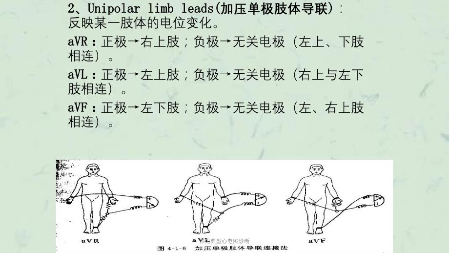 常见典型心电图诊断课件_第4页