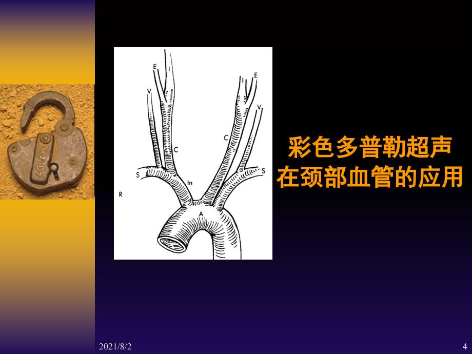 彩色多普勒超声在颈部血管的应用勇强幻灯片_第4页