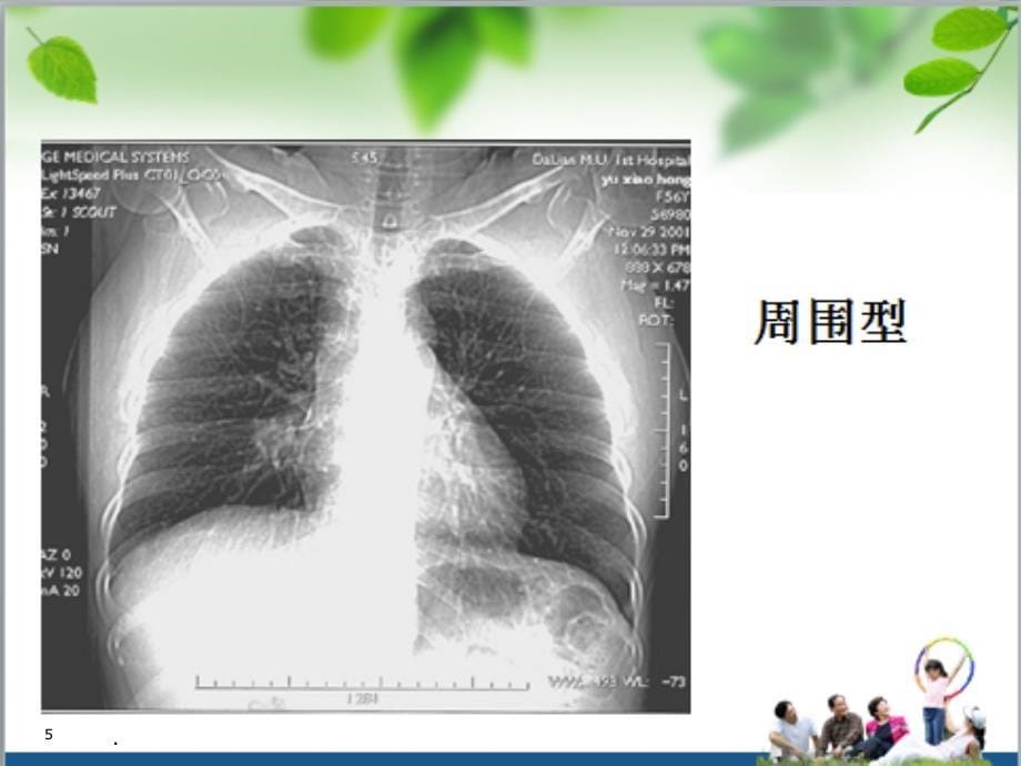 肺癌查房简洁版ppt课件_第5页