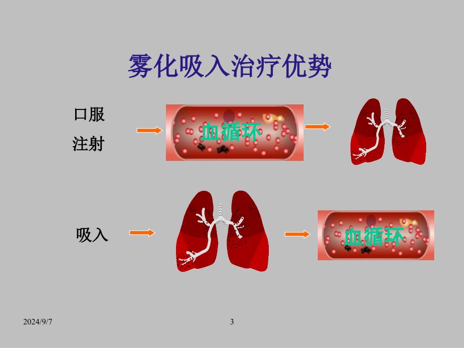 儿童常见呼吸道疾病雾化吸入药学服务_第3页