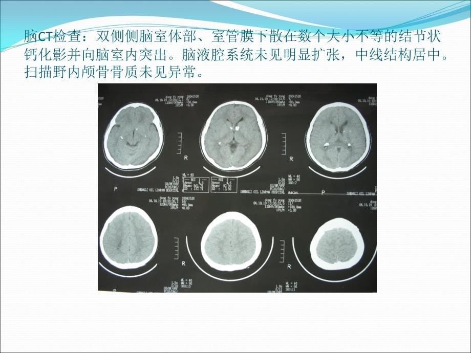 医学影像性硬化_第5页