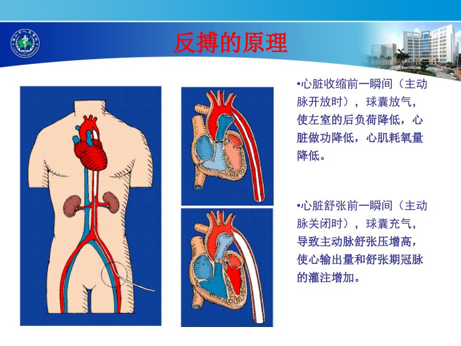 IABP临床应用课件.ppt_第4页