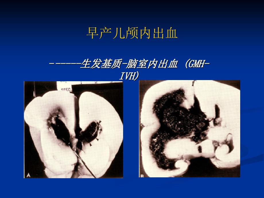 早产儿颅内出血及脑室周围白质软化_第4页