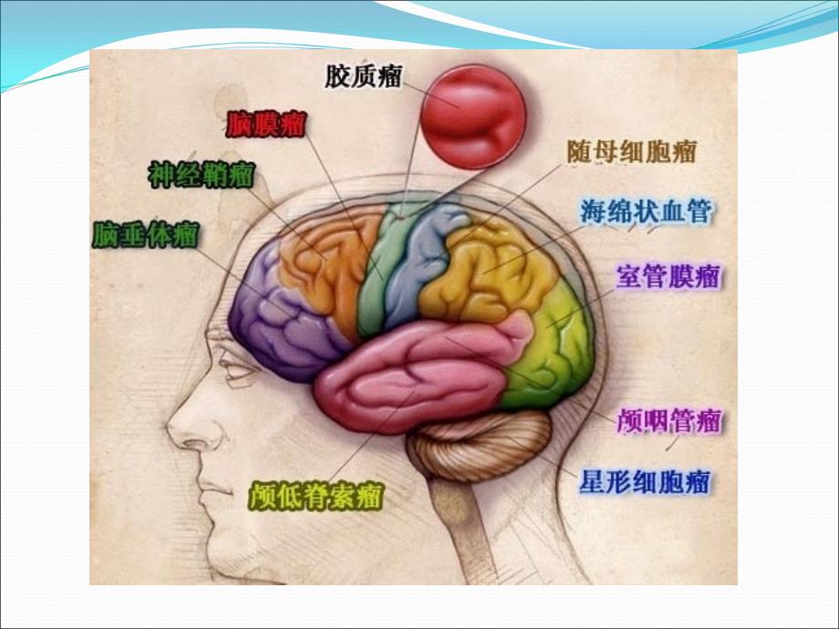 常见脑肿瘤的影像诊断.ppt.ppt_第3页