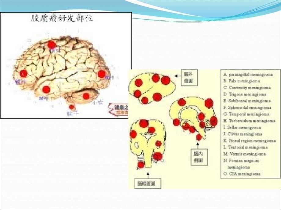 常见脑肿瘤的影像诊断.ppt.ppt_第5页